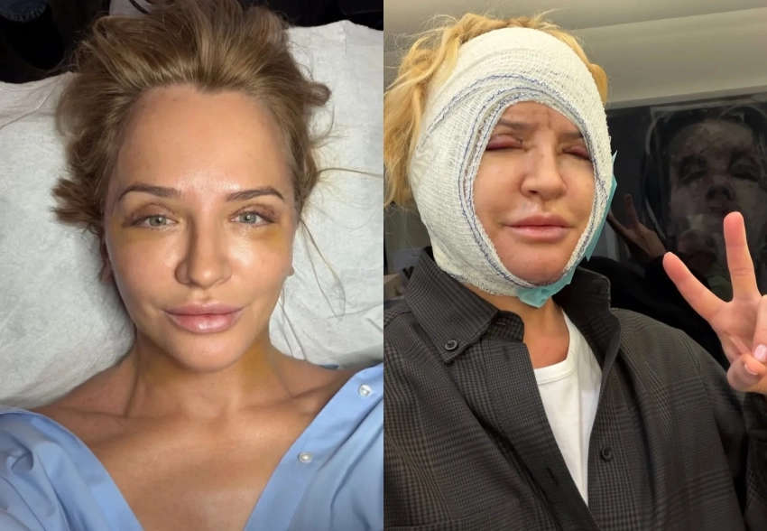 Виктория Шелягова сделала пластическую операцию на лице